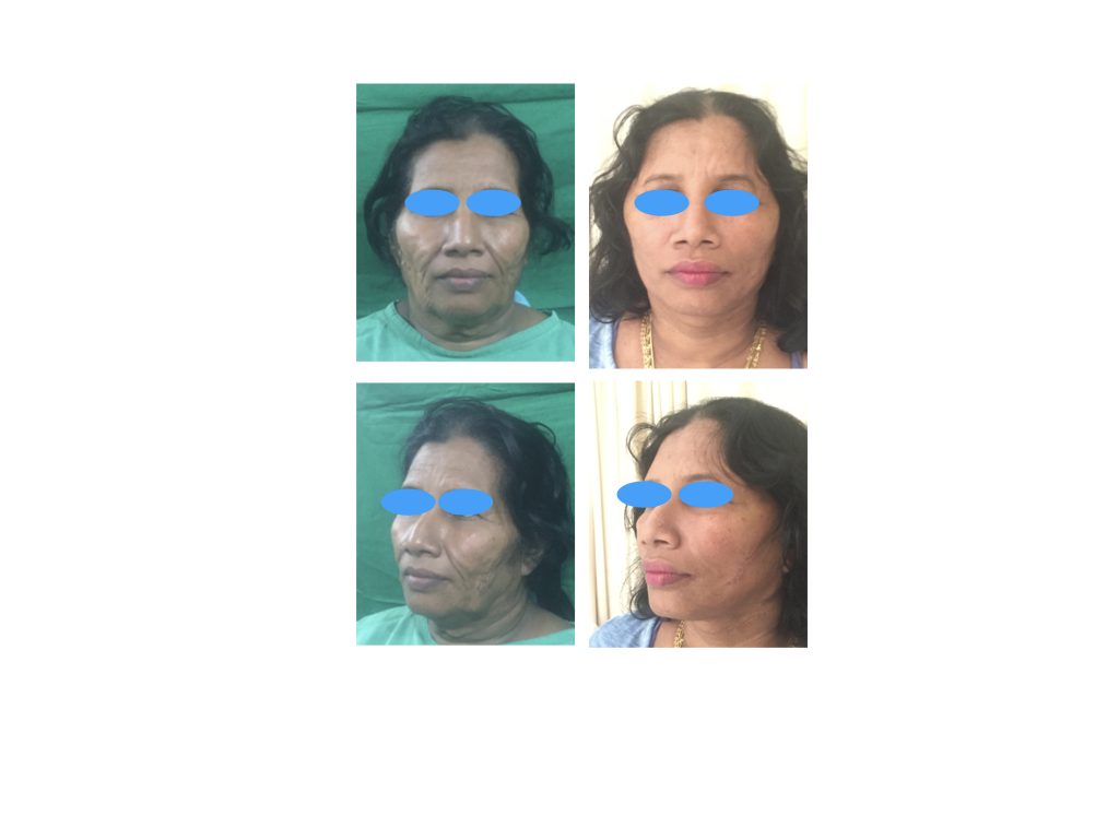 Pre and Post operative pictures of surgical face lift.. Which is an age reversing surgical procedure gives you youthful face agin in your life ..